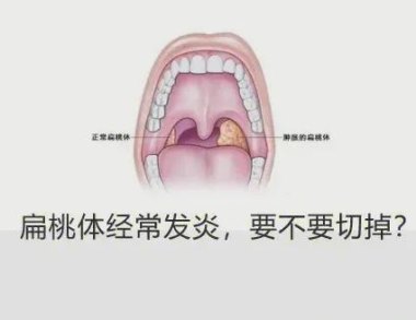3岁男孩做扁桃体切除手术致脑死亡
