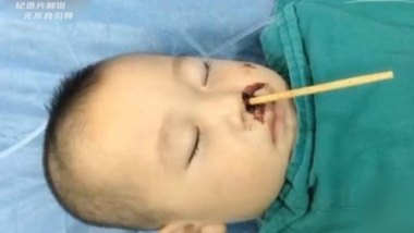 3岁男孩做扁桃体切除手术致脑死亡