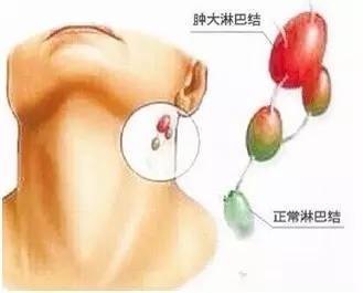 男子颈部突然肿成“鹅蛋”无法呼吸