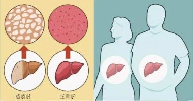 减肥为什么减出脂肪肝 减肥为什么减出脂肪肝