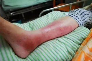 男子雨天穿洞洞鞋蹚水感染丹毒