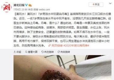 男子雨天穿洞洞鞋蹚水感染丹毒
