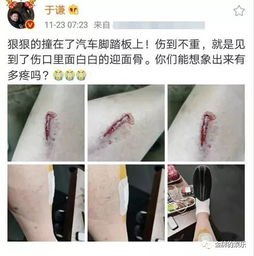 少年被干冰炸伤手指伤口深可见骨