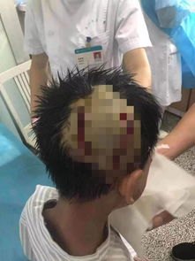 少年被干冰炸伤手指伤口深可见骨