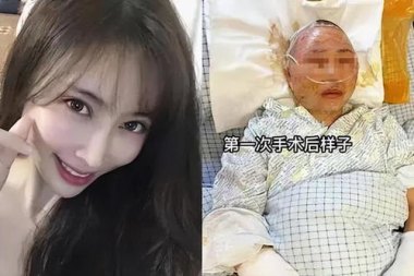 女子称逃离家暴时被泼硫酸严重毁容