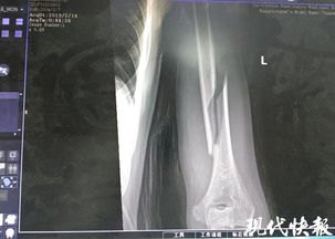 4次断骨打开折叠男孩迈出新生第一步